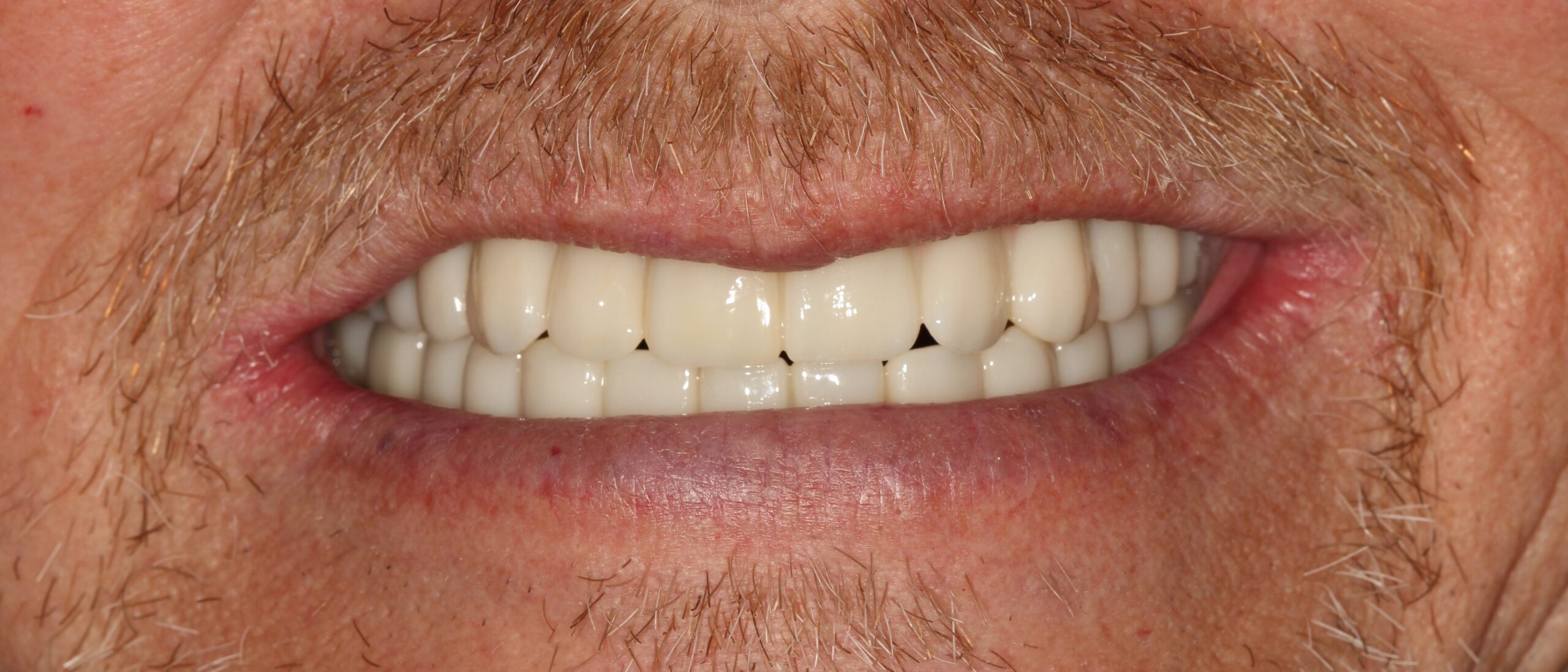 FULL MOUTH - Teeth