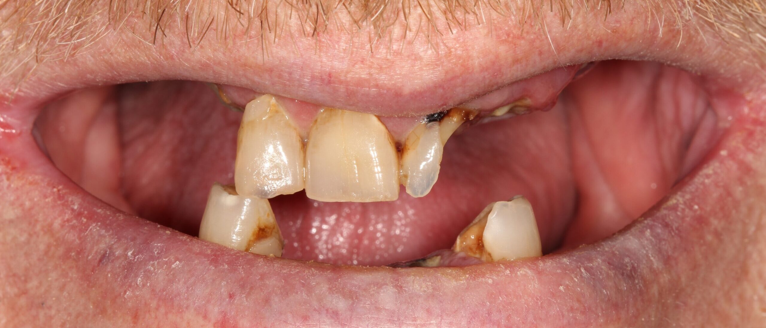 FULL MOUTH - Teeth