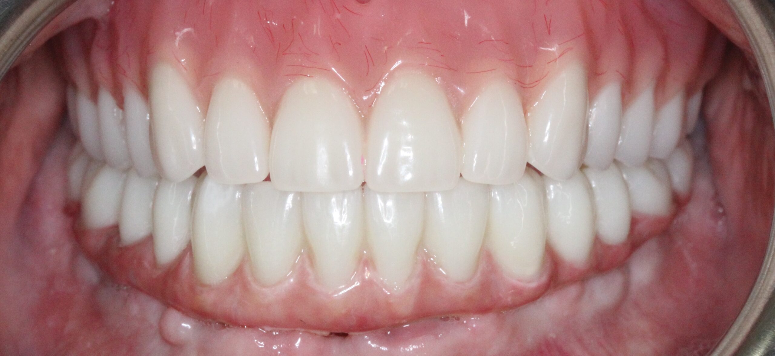 FULL MOUTH - Teeth