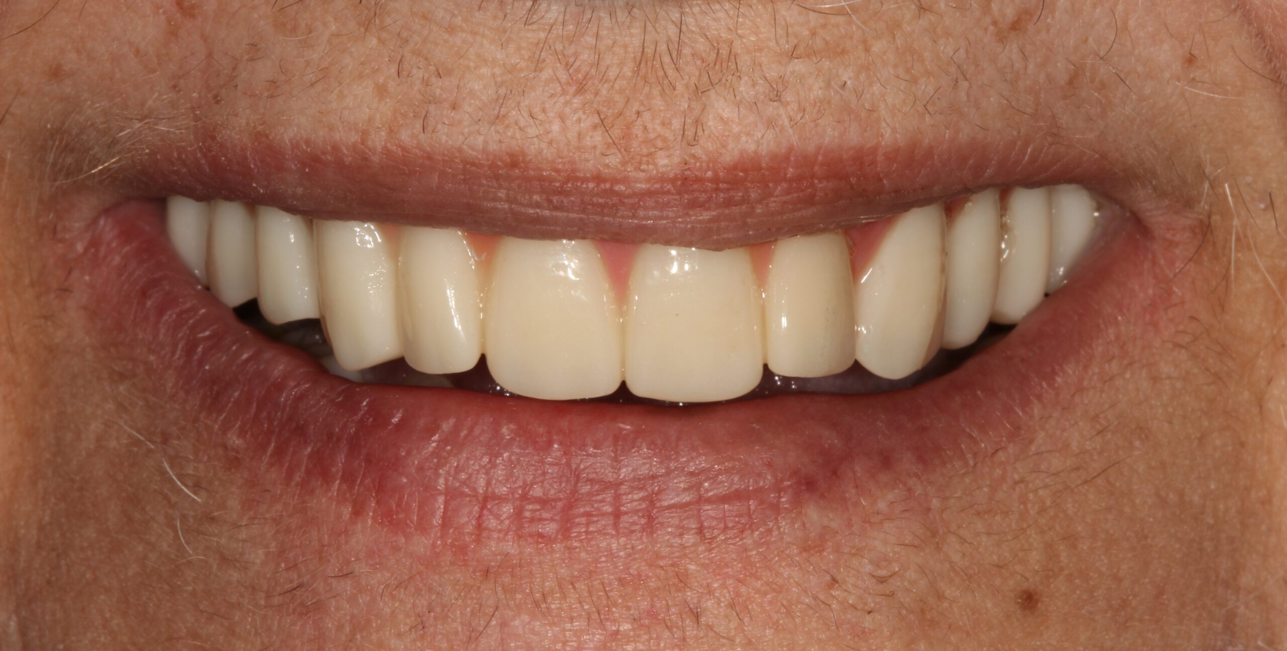 FULL MOUTH - Teeth