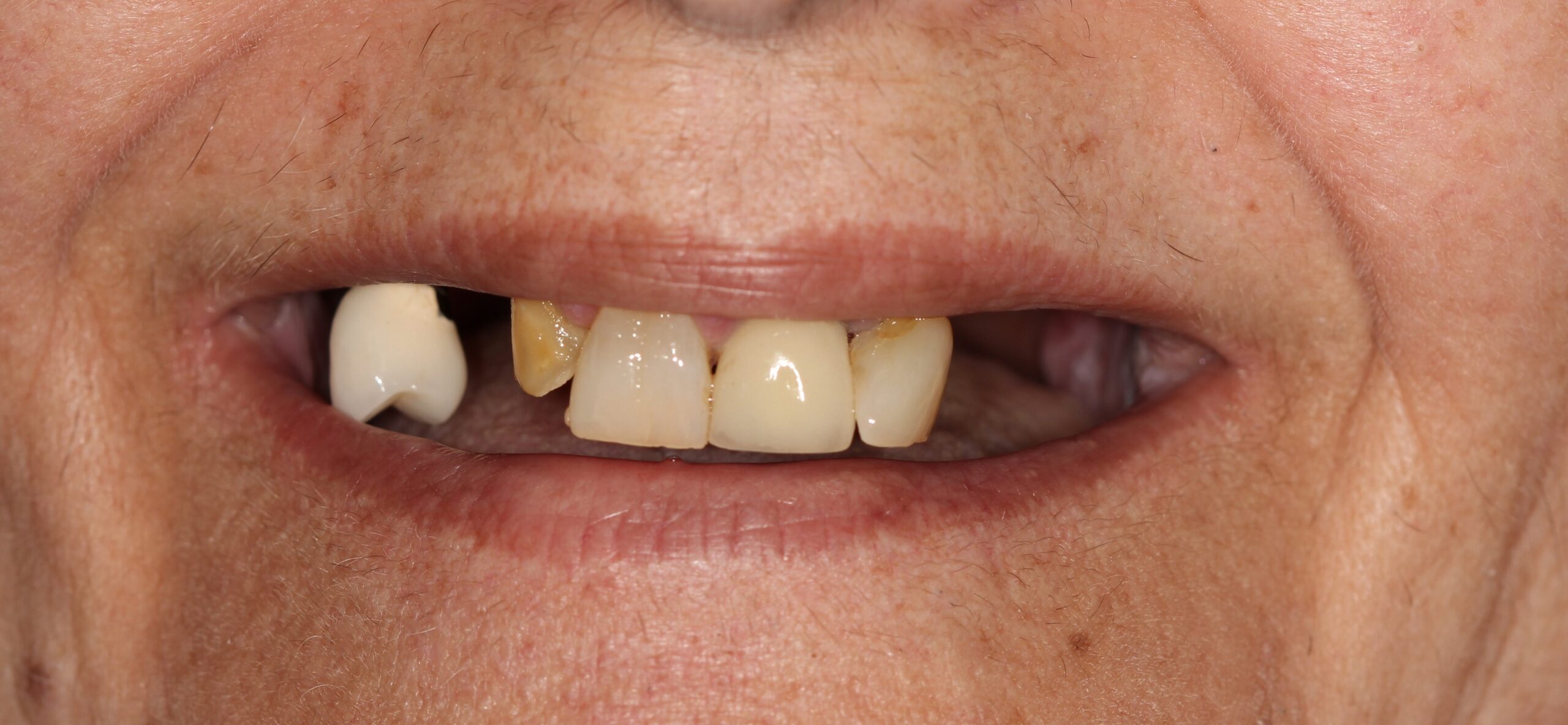 FULL MOUTH - Teeth