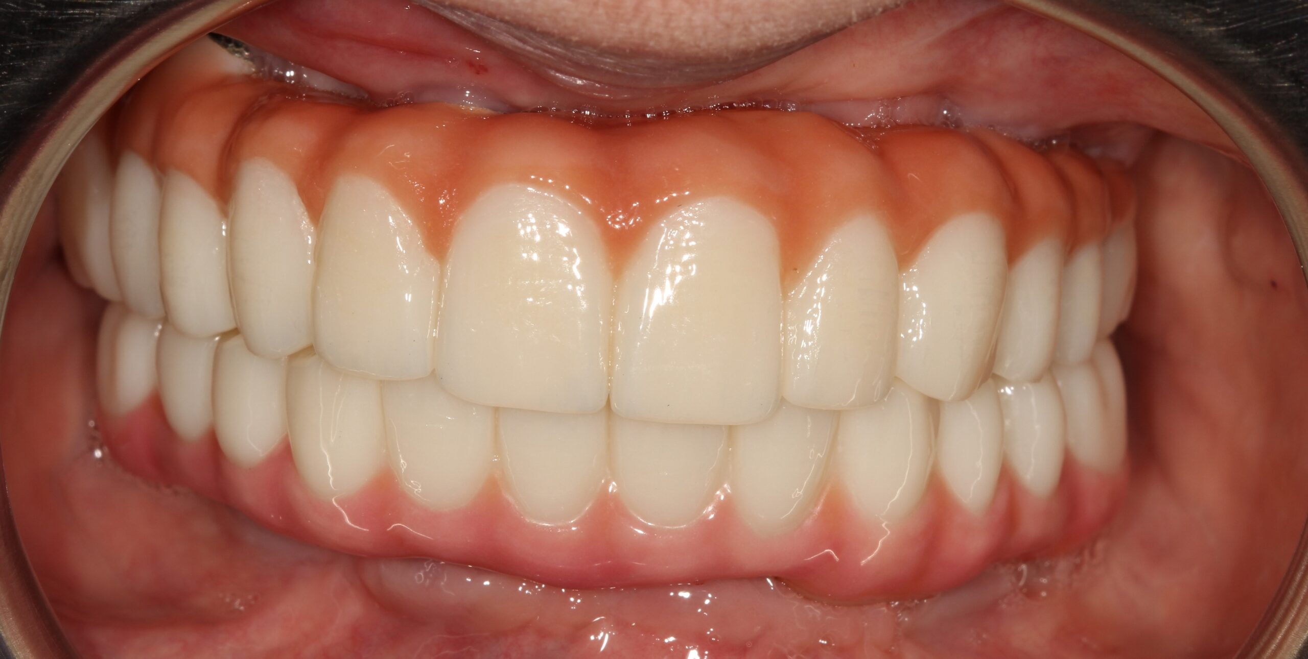 FULL MOUTH - Teeth