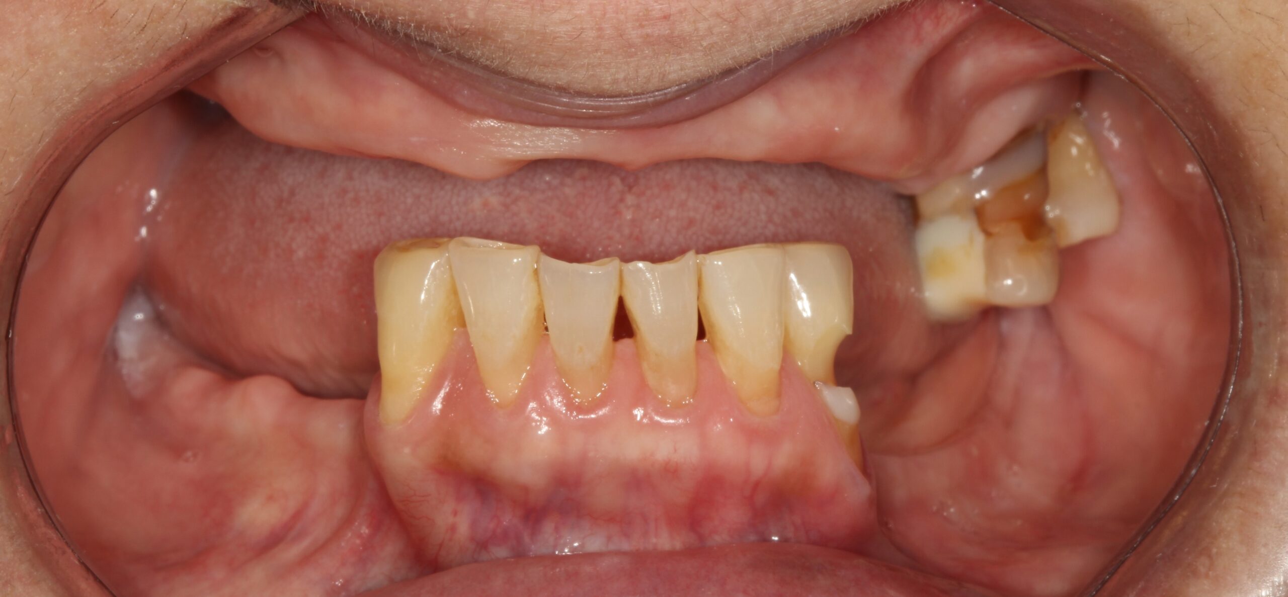 FULL MOUTH - Teeth