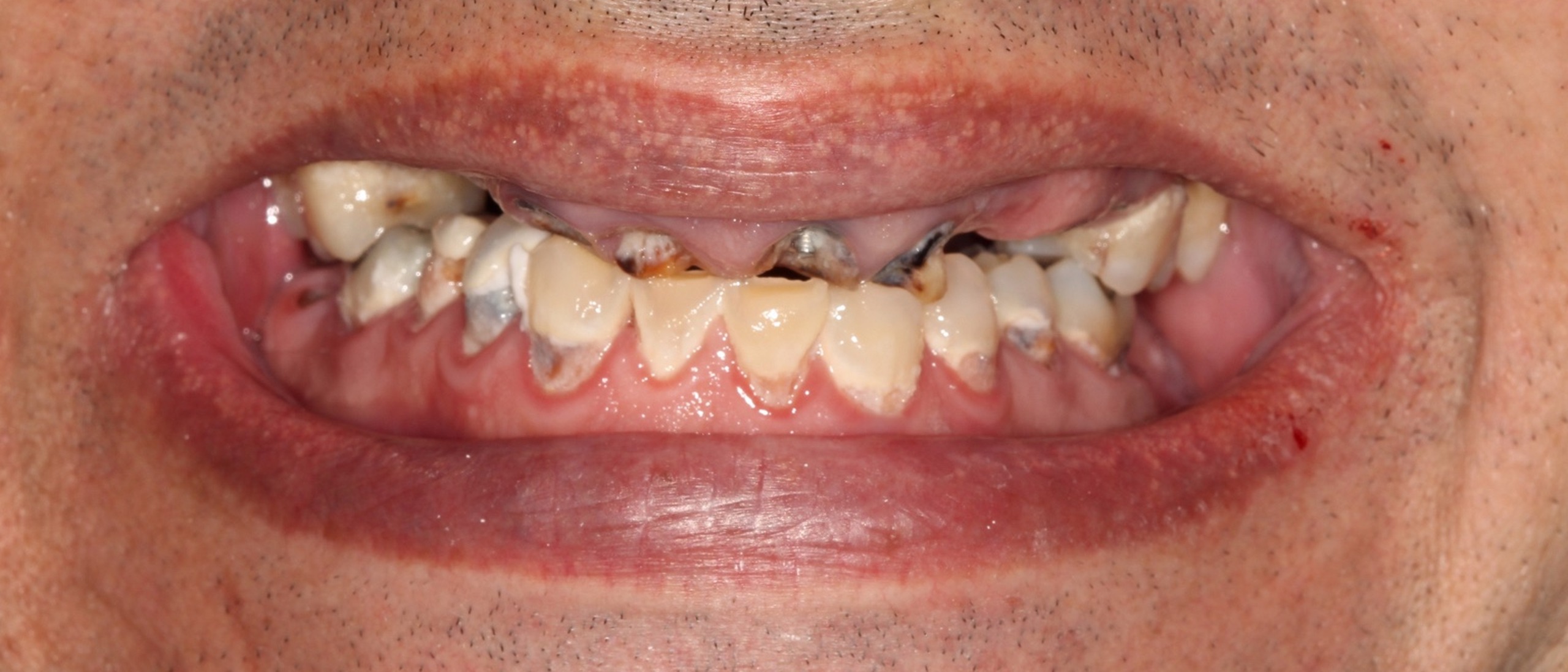 Teeth Images