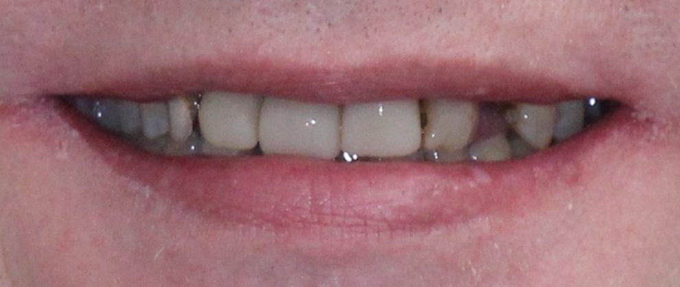 Teeth Images