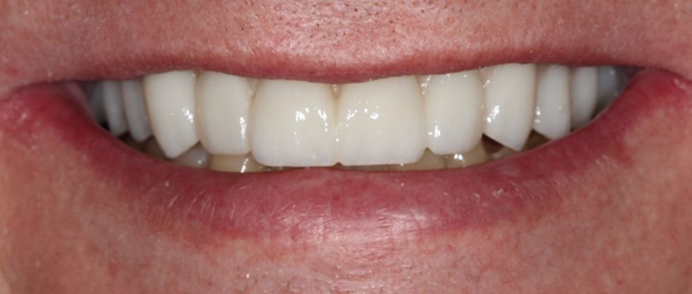 Teeth Images